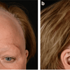 Frontal Fibrosing Alopecia (FFA): Symptoms, Causes & Wig Solutions