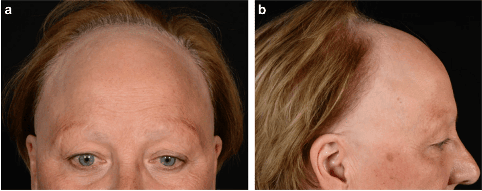 Frontal Fibrosing Alopecia (FFA): Symptoms, Causes & Wig Solutions